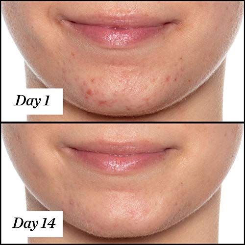 Sunday Riley U.F.O. Ultra-Clarifying BHA Salicylic Acid and Tea Tree Acne Treatment Face Oil