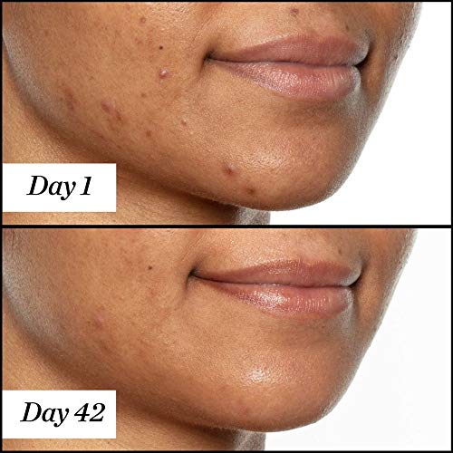Sunday Riley U.F.O. Ultra-Clarifying BHA Salicylic Acid and Tea Tree Acne Treatment Face Oil